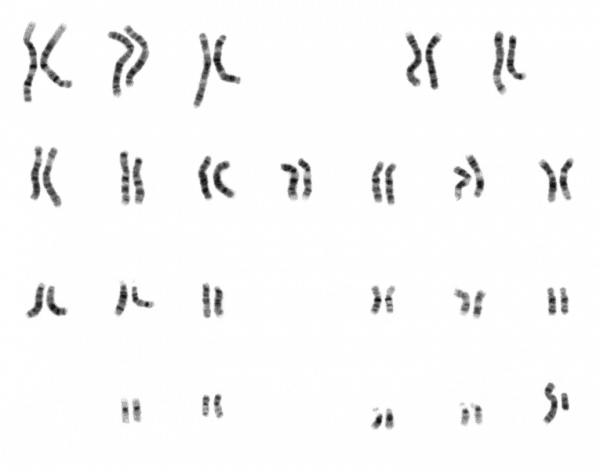 קריוטיפ זכרי - 23 זוגות הכרומוזומים של האדם, ביניהם זוג כרומוזומי המין השונים זה מזה