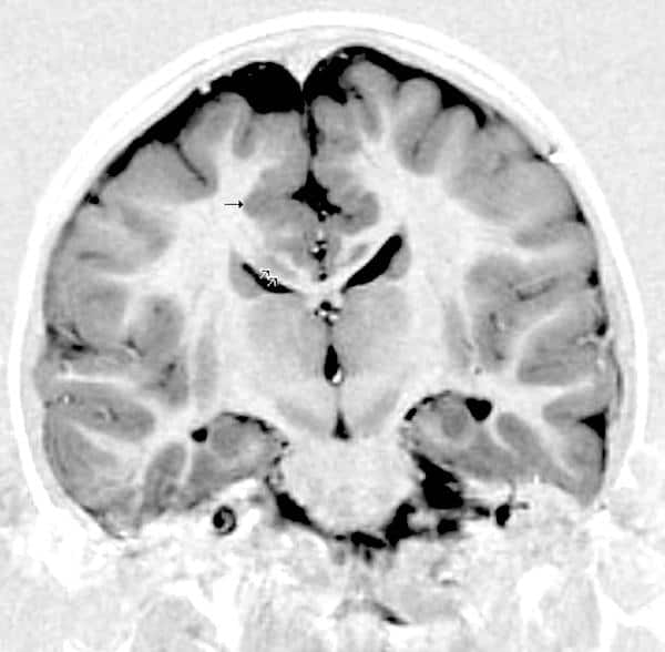 MRI של מוח בזמן התקף. החיצים מצביעים על אזור אפור שבו מתרחש ההתקף. צילום: Radiopaedia.org