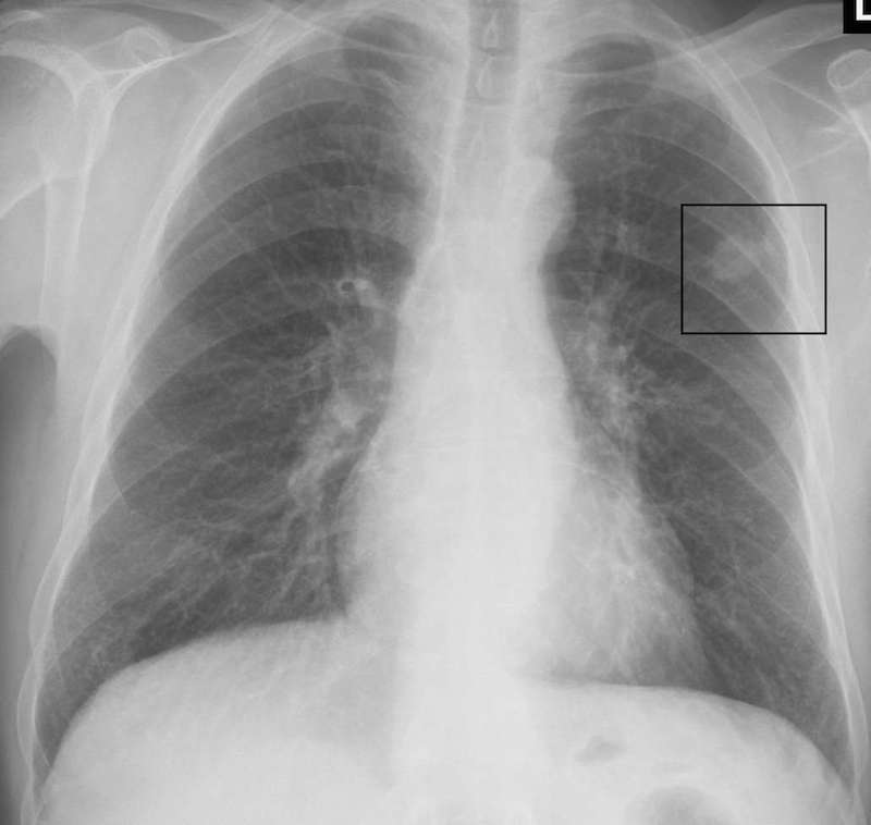 צילום רנטגן של גידול סרטני בריאות, כפי שמסומן מימין.